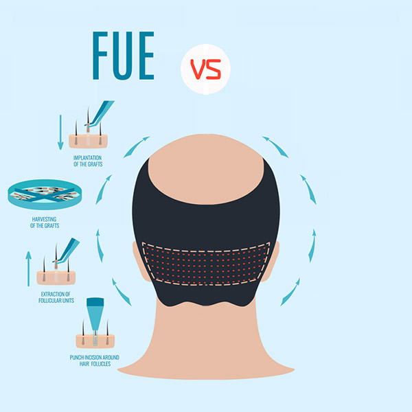 FUE and FUT hair transplant procedures Dr. Kayihan Sahinoglu